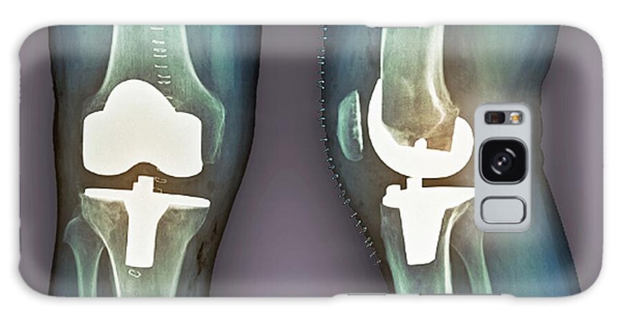 Artificial Galaxy Case featuring the photograph Total Knee Replacement, X-rays by Zephyr