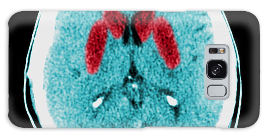 Area Of Infarction Galaxy Case featuring the photograph Brain Of A Cardiac Arrest Victim by Medical Body Scans