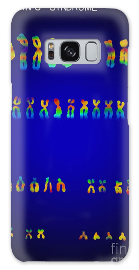 Down's Syndrome Galaxy Case featuring the photograph Downs Syndrome Karyotype by Omikron