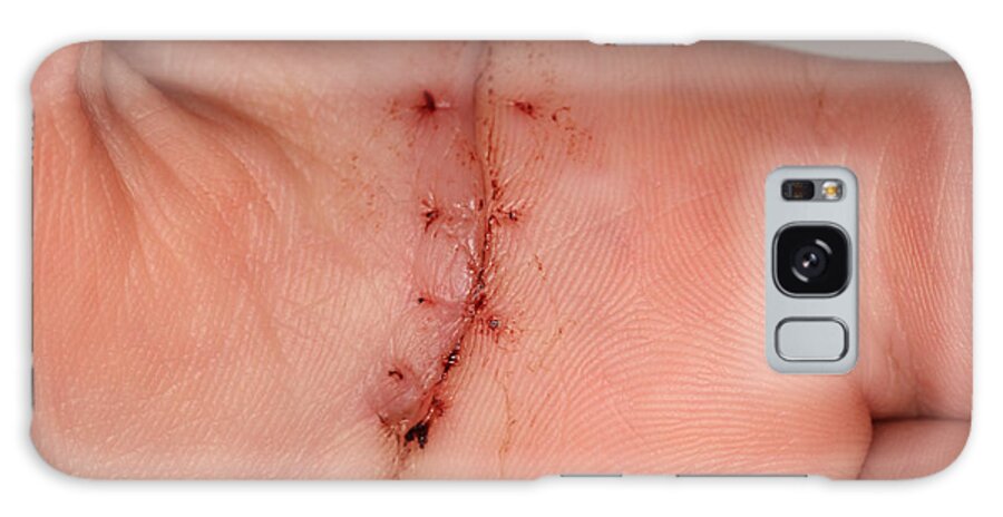 Science Galaxy Case featuring the photograph Wound Healing Day 10 by Ted Kinsman