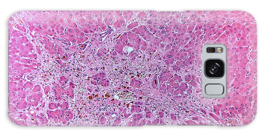 Carbon Tetrachloride Galaxy Case featuring the photograph Lm Of Toxic Liver Disease #1 by Jose Luis Calvo
