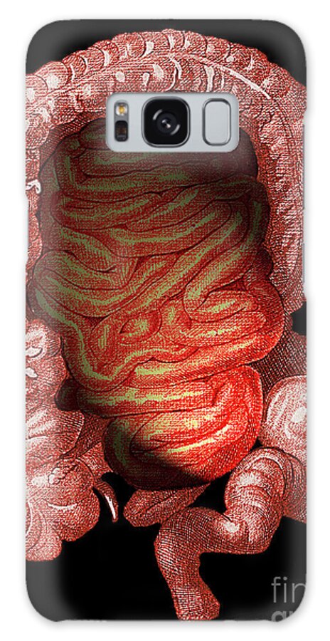 Irritable Bowel Syndrome Galaxy Case featuring the photograph Irritable Bowel Syndrome by Sheila Terry/science Photo Library