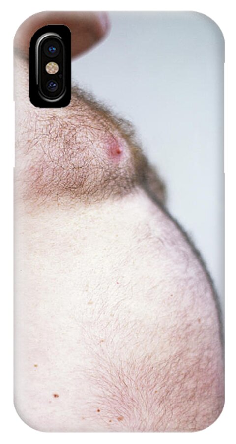 Human iPhone X Case featuring the photograph Obesity by Ian Hooton/science Photo Library