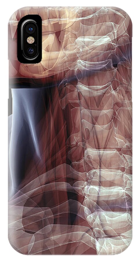 Transparent iPhone X Case featuring the photograph The Muscles Of The Neck by Science Picture Co