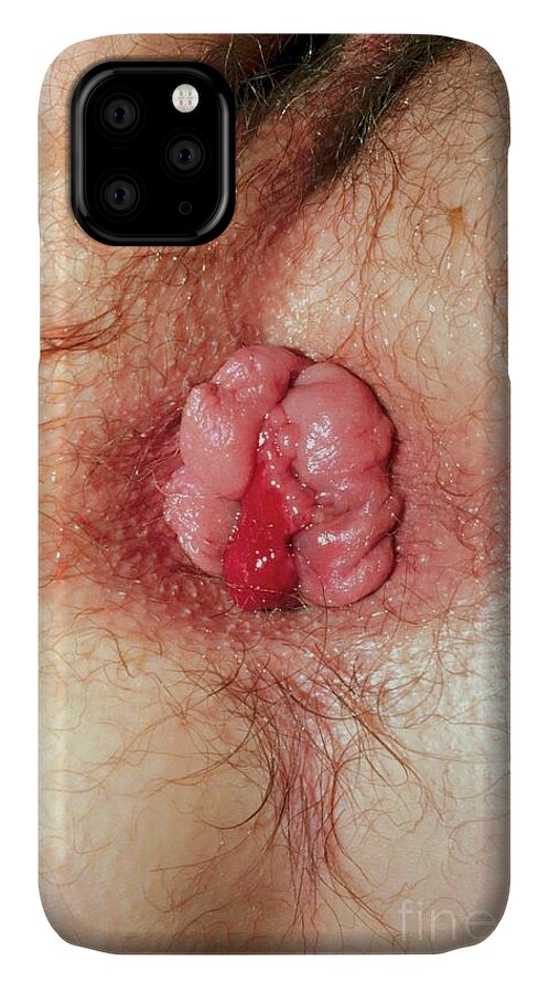 https://render.fineartamerica.com/images/rendered/default/phone-case/iphone11/images/artworkimages/medium/2/1-haemorrhoids-dr-larpentgrehgepscience-photo-library.jpg?&targetx=-23&targety=0&imagewidth=617&imageheight=951&modelwidth=571&modelheight=951&backgroundcolor=A86751&orientation=0