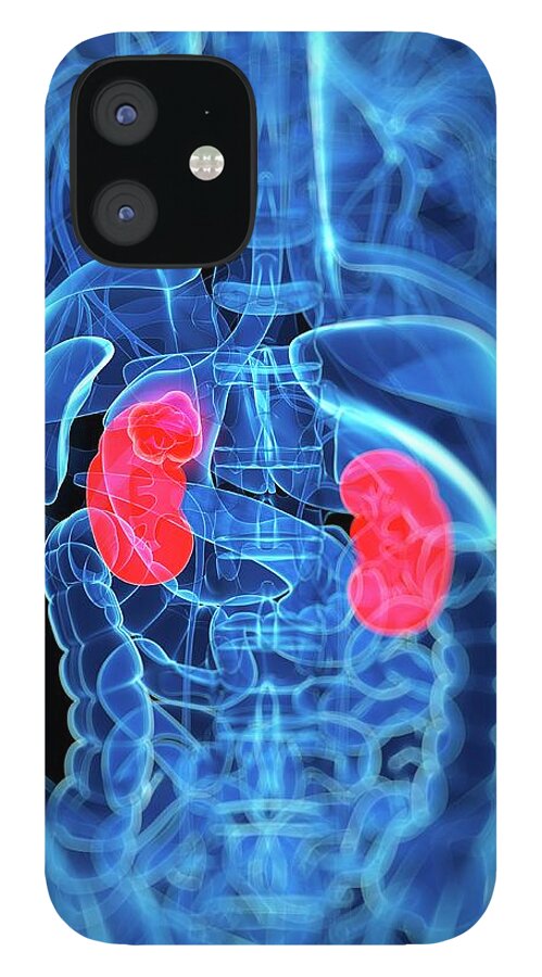 Pelvis iPhone 12 Case featuring the digital art Kidney Cancer, Artwork by Sciepro
