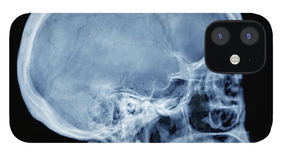 Physiology iPhone 12 Case featuring the photograph Normal Skull, X-ray by Zephyr