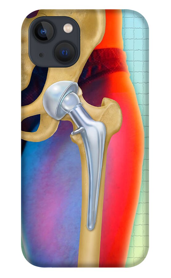 Art iPhone 13 Case featuring the photograph Prosthetic Hip Replacement by Chris Bjornberg