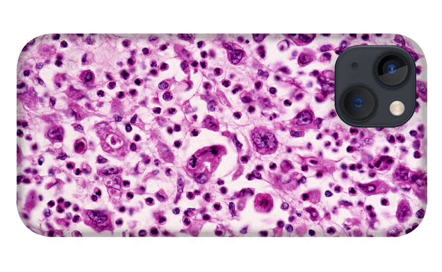 Abnormal iPhone 13 Case featuring the photograph Giant-cell Carcinoma Of The Lung, Lm by Michael Abbey