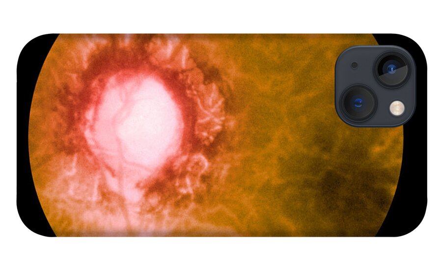 Bacteria iPhone 13 Case featuring the photograph Retina Infected By Syphilis by Science Source