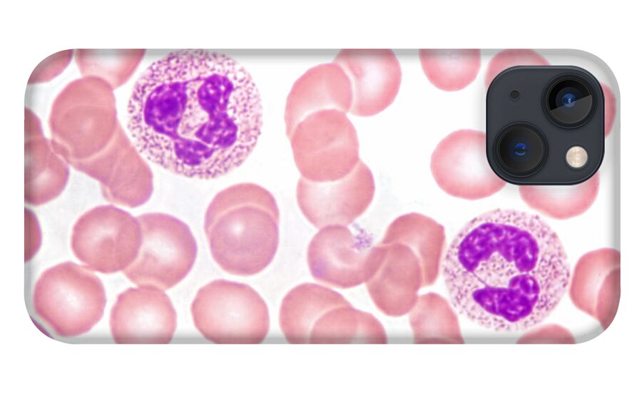 Neutrophil Polymorphs iPhone 13 Case featuring the photograph Neutrophils In Peripheral Blood Smear by M. I. Walker