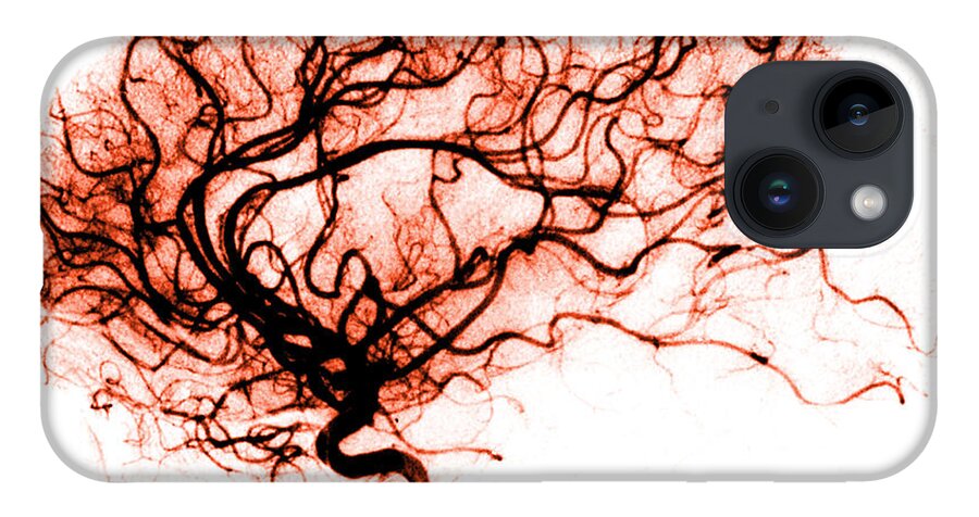 Catheter Cerebral Angiogram iPhone Case featuring the photograph Cerebral Angiogram by Medical Body Scans