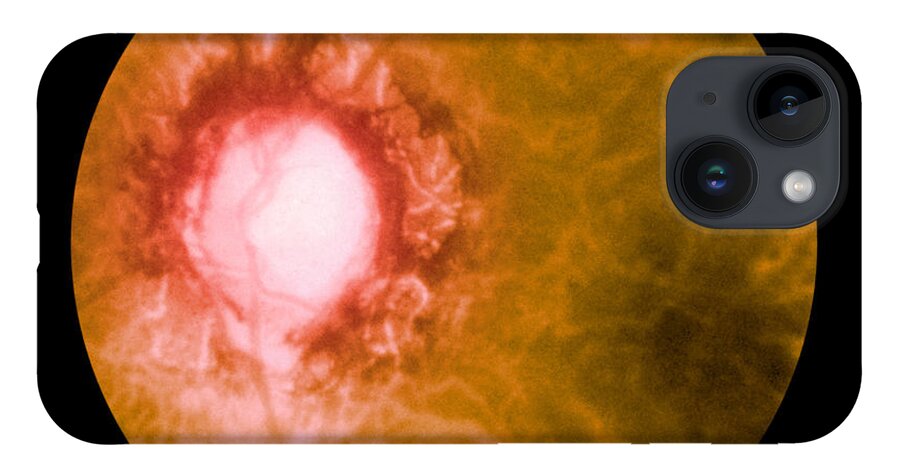 Bacteria iPhone 14 Case featuring the photograph Retina Infected By Syphilis by Science Source