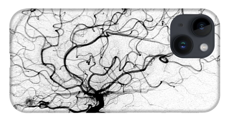 Cerebral Angiogram iPhone 14 Case featuring the photograph Dural Arterial Venous Fistula, Angiogram by Living Art Enterprises