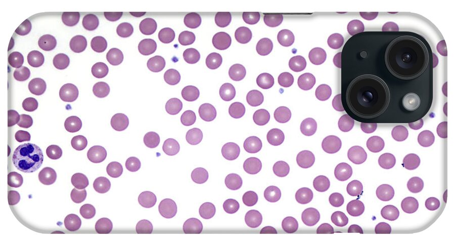 Blood Smear iPhone Case featuring the photograph Blood Smear, Lm #3 by Alvin Telser