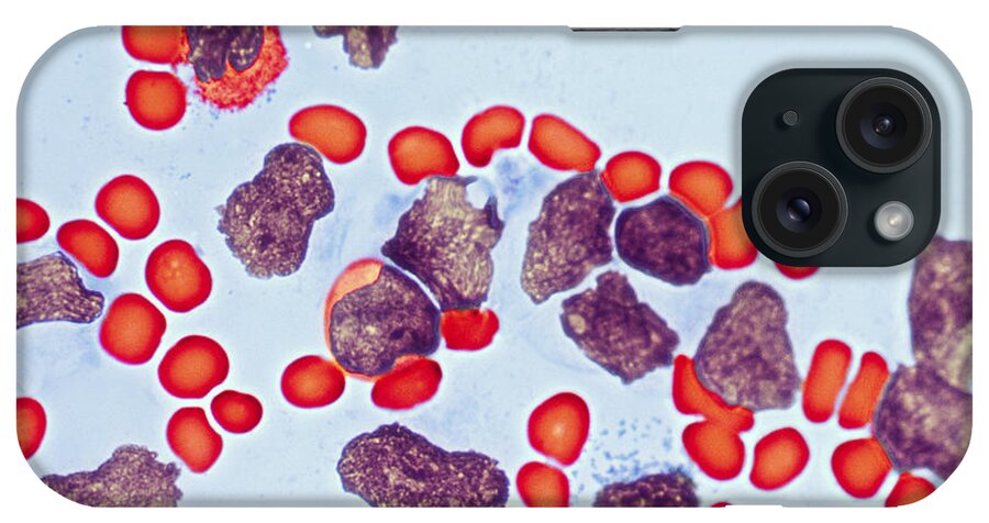 Leukemia iPhone Case featuring the photograph Leukemia #1 by Biology Pics