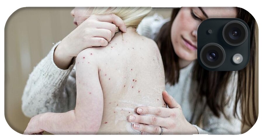 Varicella iPhone Case featuring the photograph Mother Treating Daughter With Chickenpox #1 by Samuel Ashfield/science Photo Library