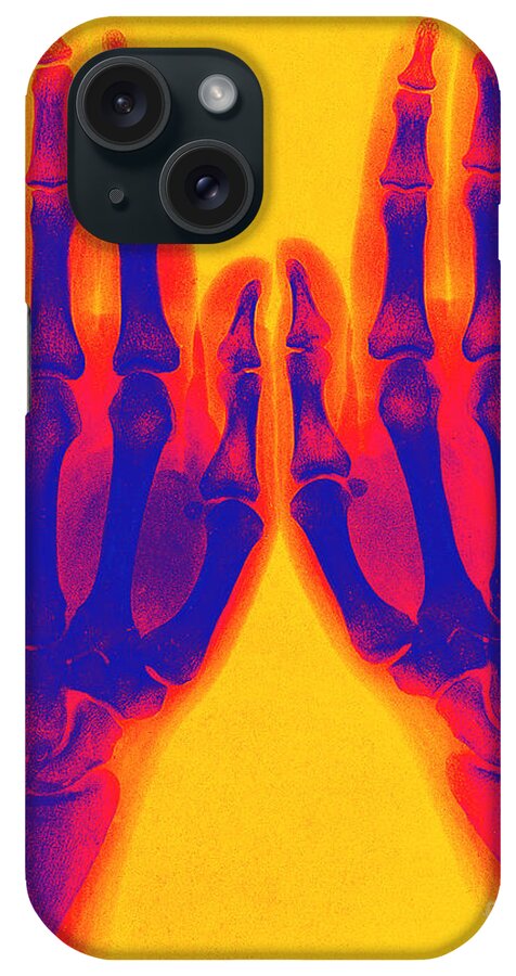Historic iPhone Case featuring the photograph X-ray Of Two Normal Hands 1896 #3 by Science Source