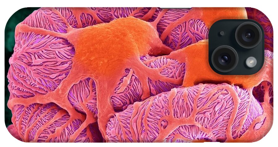 Scanning Electron Micrograph iPhone Case featuring the photograph Kidney Glomerulus #11 by Dennis Kunkel Microscopy/science Photo Library