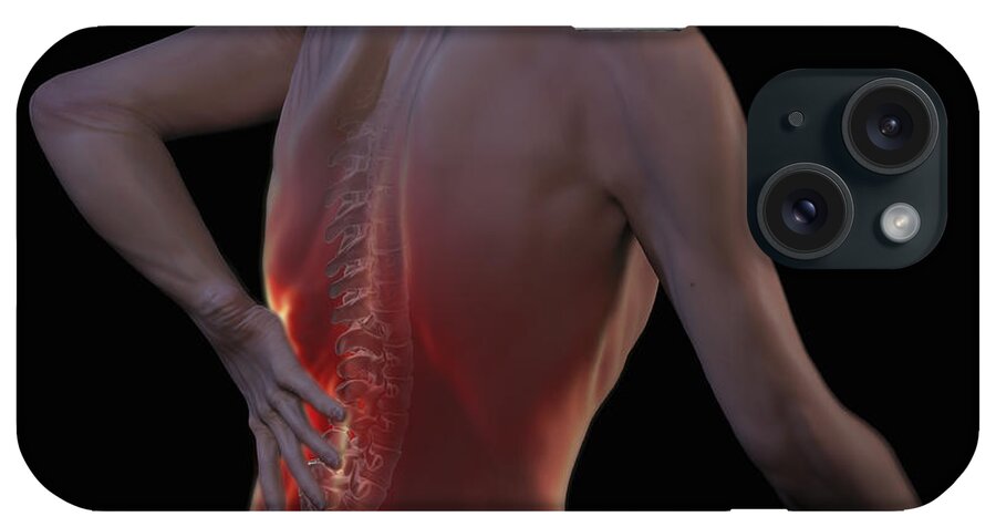 Back Ache iPhone Case featuring the photograph Back Pain #3 by Science Picture Co