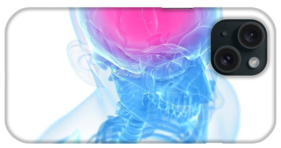 Anatomy iPhone Case featuring the photograph Headache #62 by Sciepro/science Photo Library