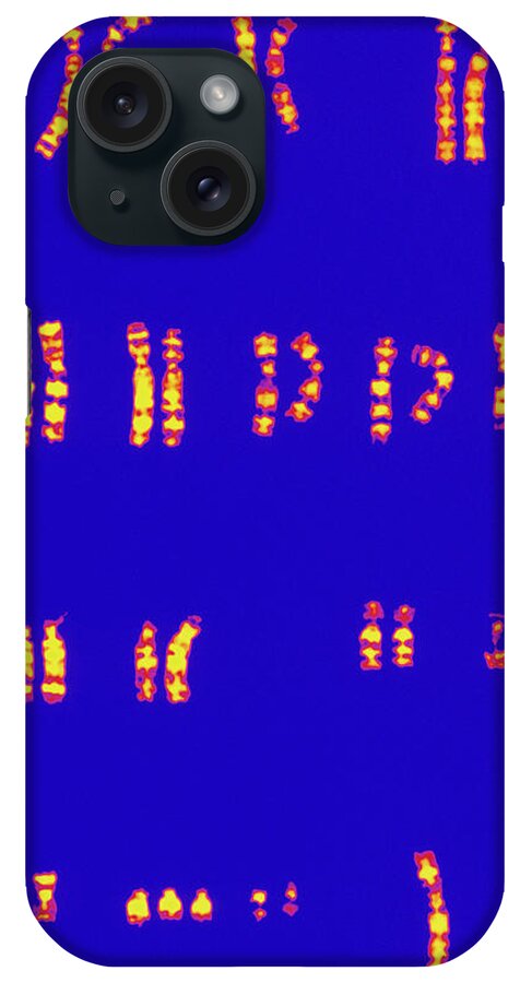 Chromosomes iPhone Case featuring the photograph Col Karyotype Of Chromosomes In Down's Syndrome by L. Willatt, East Anglian Regional Genetics Service/science Photo Library