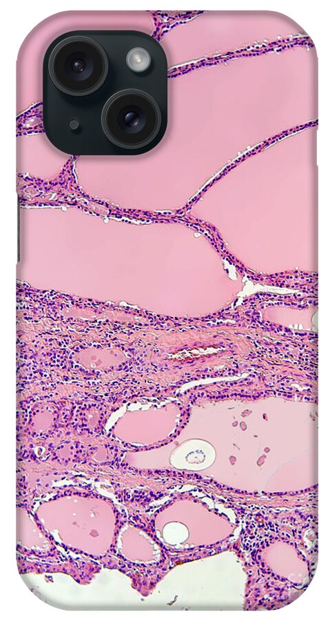Micrograph iPhone Case featuring the photograph Colloid Nodular Goiter, Lm by Garry DeLong