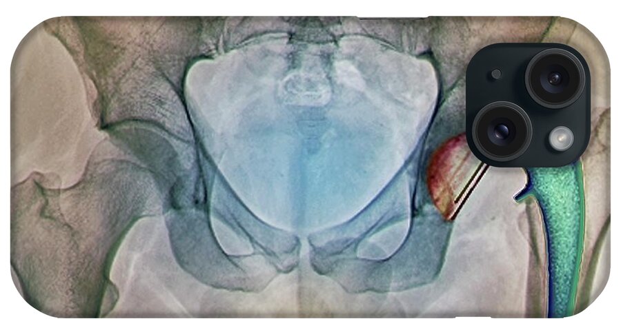 Artificial iPhone Case featuring the photograph Dislocated Hip Replacement, X-ray by Zephyr