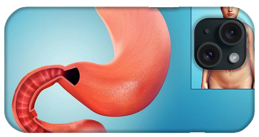 Artwork iPhone Case featuring the photograph Female Stomach And Duodenum by Pixologicstudio/science Photo Library