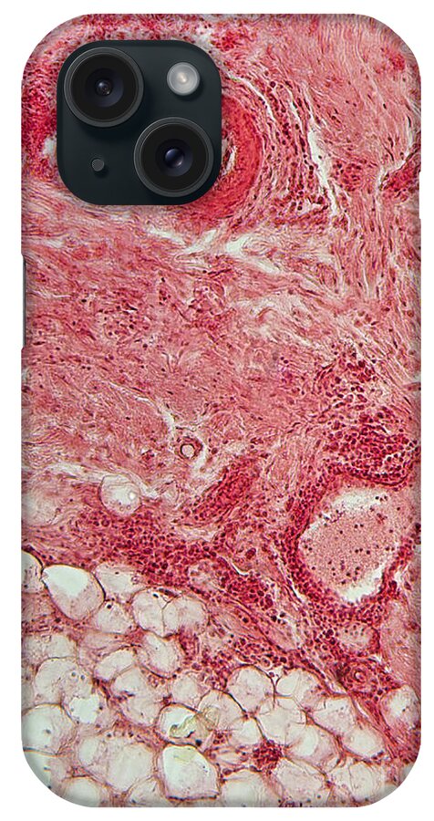 Light Micrograph iPhone Case featuring the photograph Lm Of Lupus Skin Lesion by Garry DeLong