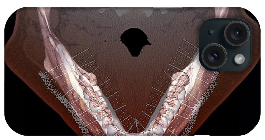 Tooth iPhone Case featuring the photograph Lower Jaw And Teeth by Zephyr/science Photo Library