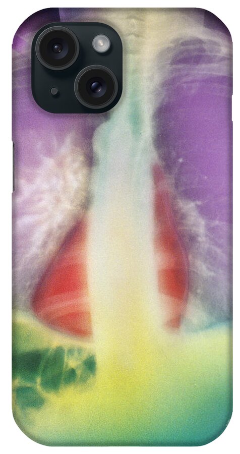Lung iPhone Case featuring the photograph Lung Cancer, X-ray by Chris Bjornberg