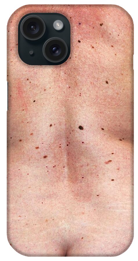 Human iPhone Case featuring the photograph Moles On A Woman's Back by Dr M.a. Ansary/science Photo Library