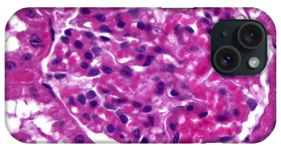 Kidney iPhone Case featuring the photograph Renal Corpuscle, Lm by Alvin Telser