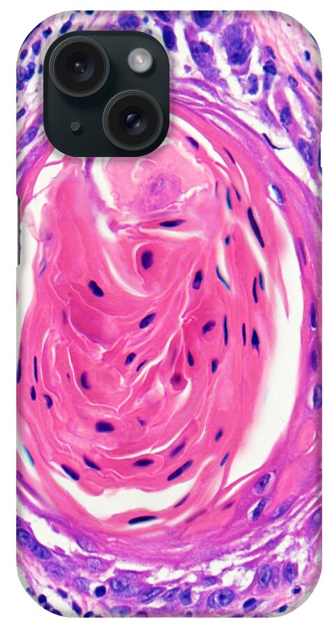 Light Micrograph iPhone Case featuring the photograph Squamous Cell Carcinoma, Keratin Pearl by Garry DeLong
