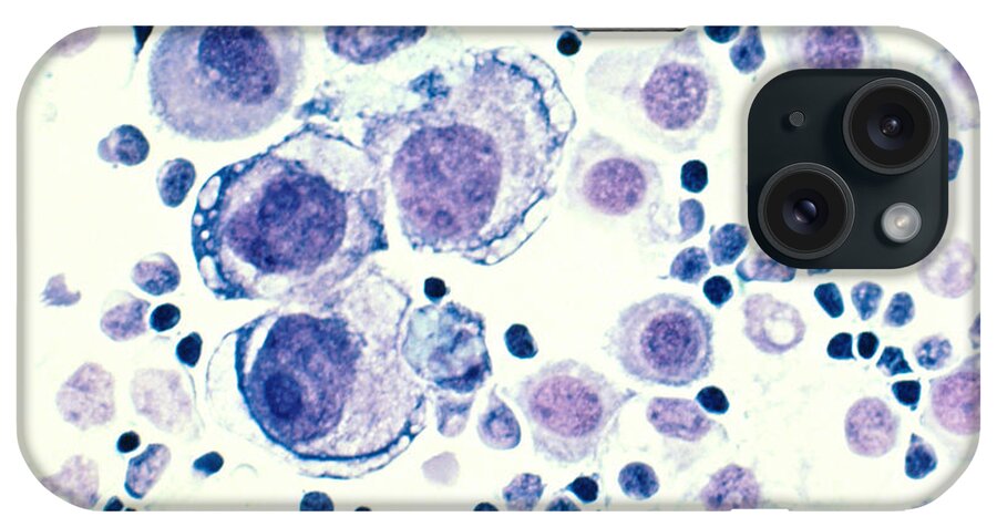 Metastatic iPhone Case featuring the photograph Breast Cancer #1 by Science Source