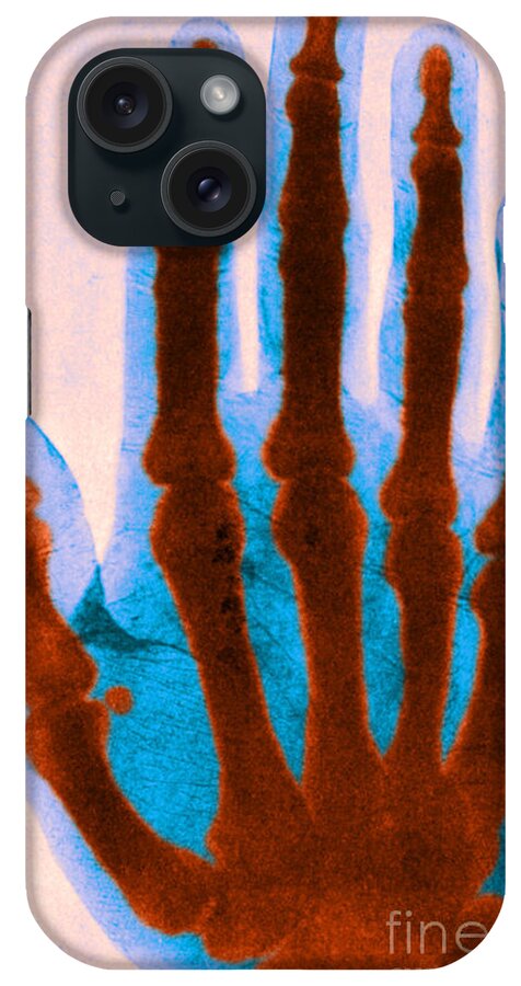 Science iPhone Case featuring the photograph Early X-ray #1 by Science Source