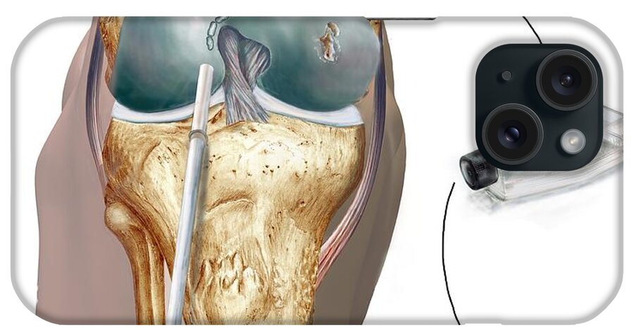 Knee Cartilage Reconstruction iPhone Case featuring the photograph Knee Cartilage Reconstruction, Artwork #1 by D & L Graphics