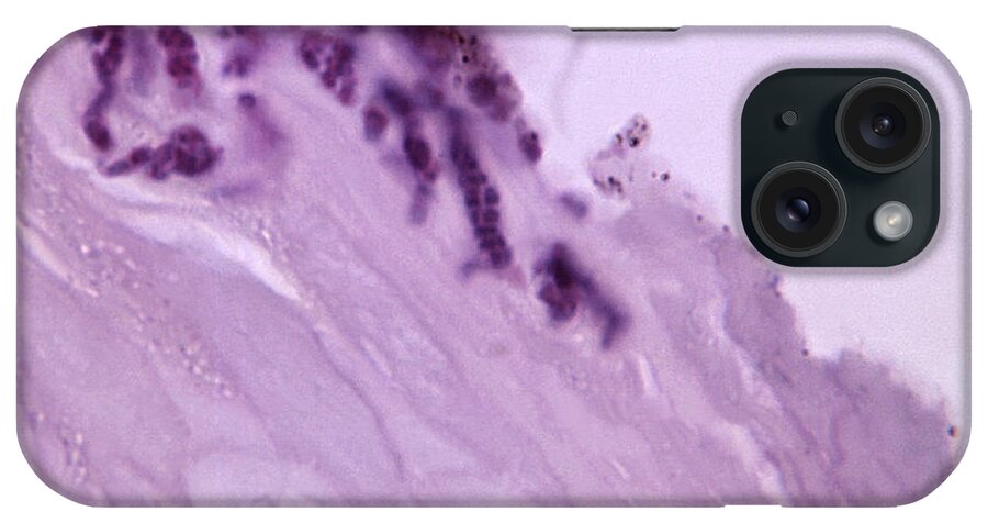 Science iPhone Case featuring the photograph Pitted Keratolysis, Lm #1 by Science Source