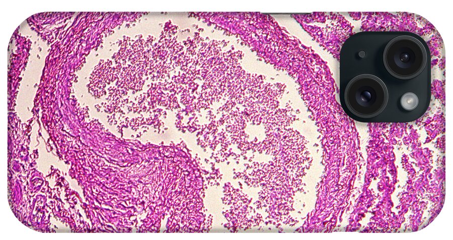 Infection iPhone Case featuring the photograph The Effects Of Hiv On Human Lung Tissue #1 by Ted Kinsman