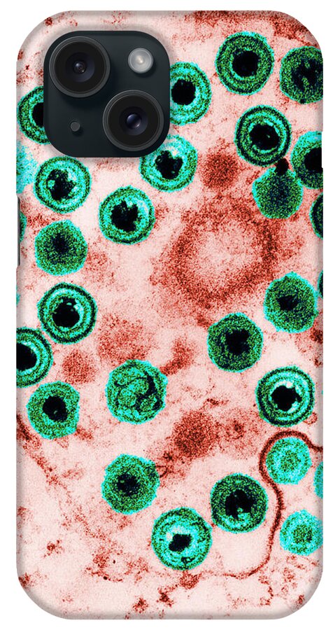 Disease iPhone Case featuring the photograph Herpes #3 by Science Source