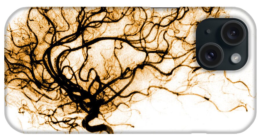 Catheter Cerebral Angiogram iPhone Case featuring the photograph Cerebral Angiogram #4 by Medical Body Scans
