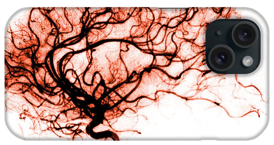 Catheter Cerebral Angiogram iPhone Case featuring the photograph Cerebral Angiogram #5 by Medical Body Scans