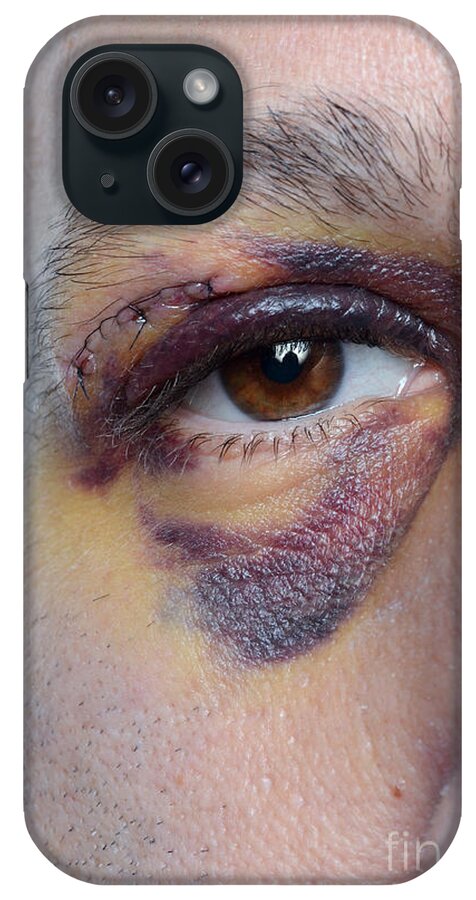 Black Eye Photo Case - iPhone - Black Eye