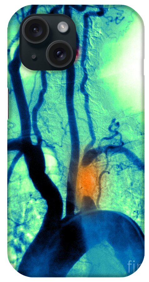 Abnormal Angiogram iPhone Case featuring the photograph Aortic Arch Angiogram by Medical Body Scans