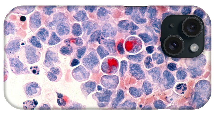 Myelocytic Leukemia iPhone Case featuring the photograph Myelocytic Leukemia by Science Source