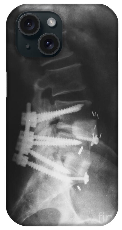 Lumbar Spinal Fusion iPhone Case featuring the photograph Lumbar Spinal Fusion by Olga Hamilton