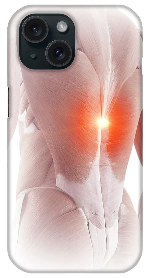 3d iPhone Case featuring the photograph Illustration Of Back Muscle Pain #1 by Sebastian Kaulitzki/science Photo Library