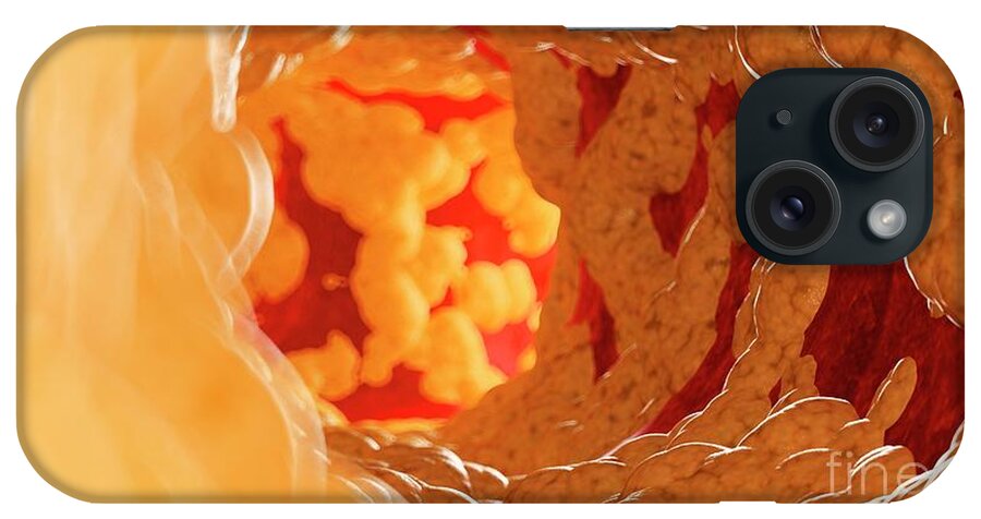 3d iPhone Case featuring the photograph Illustration Of Fat Inside Of An Artery #11 by Sebastian Kaulitzki/science Photo Library