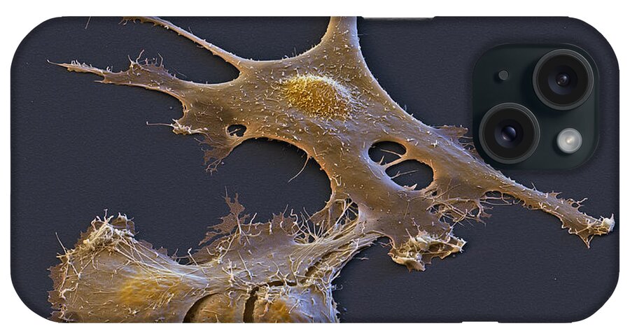Brain Tumor iPhone Case featuring the photograph Ependymoma Cancer Cells, Sem #2 by Meckes/ottawa